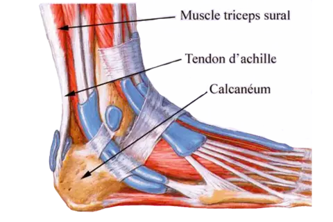 Anatomie du pied montrant le muscle triceps sural, le tendon d'Achille et le calcanéum. Illustration d'une tendinite du tendon d'Achille.