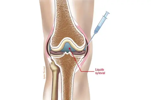 Illustration d'une injection d'acide hyaluronique dans le genou. Avis sur cette procédure pour soulager la douleur.