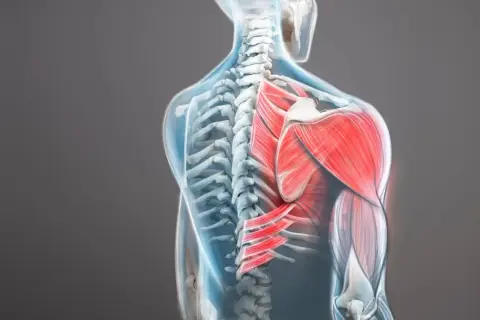 Vue anatomique du dos montrant une contracture trapèze qui ne passe pas, avec les muscles en rouge vif.