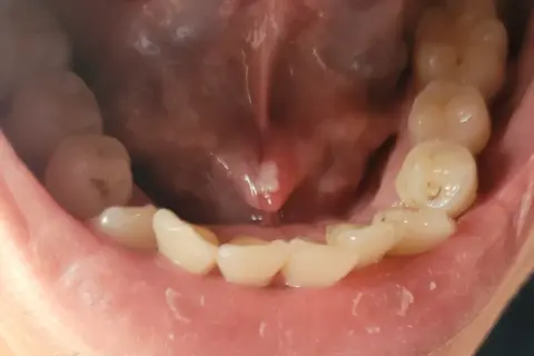Un petit bouton blanc est visible sous la langue, près de la base. Les dents du bas sont également visibles.