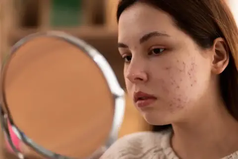 Jeune femme examinant son visage dans un miroir, préoccupée par l'acné et les imperfections de sa peau. Le zinc pourrait aider.