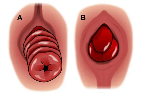 Illustration A montre un prolapsus rectal en plusieurs couches, tandis que B illustre un prolapsus d'organe chez l'homme.