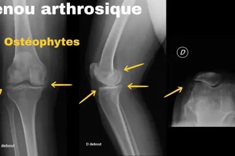 Radiographies du genou montrant un arthrose genou stade 4 avec ostéophytes marqués, rétrécissement de l'espace articulaire et déformations osseuses.