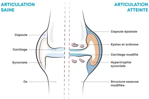 Comparaison d'une articulation saine et d'une articulation atteinte d'arthrose, montrant les symptômes : cartilage modifié, kystes, hypertrophie synoviale.