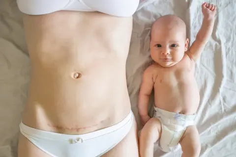 Ventre après césarienne, avec une cicatrice visible, à côté d'un bébé souriant.