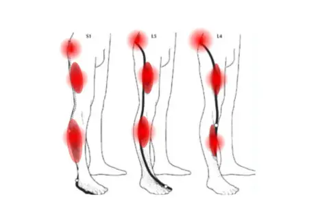Schéma montrant les zones de douleur du nerf sciatique, incluant le mollet, avec des points rouges indiquant l'inflammation.