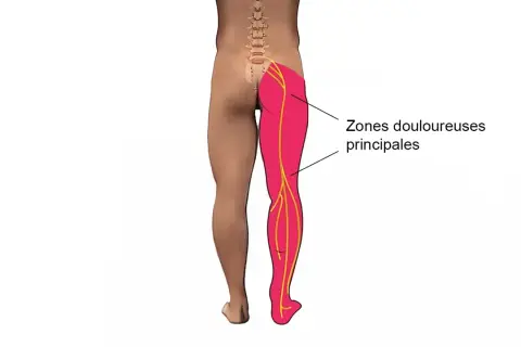 Douleur irradiant de la fesse, le long de la cuisse, jusqu'au pied. Zones douloureuses principales.