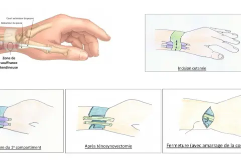 Illustrations montrant la zone de souffrance tendineuse au poignet, les étapes d'une ténosynovectomie et la fermeture. Ces symptômes de tendinite au poignet peuvent nécessiter une intervention.