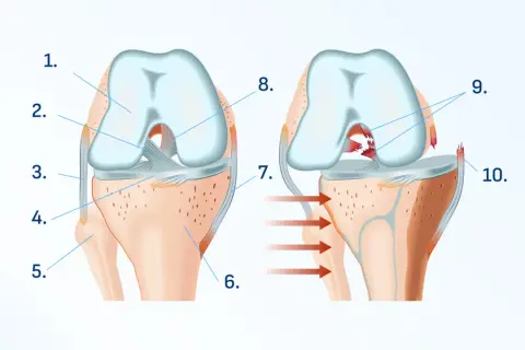 Illustration du genou montrant une déchirure ligamentaire interne. Aide à comprendre comment soigner douleur genou interne.