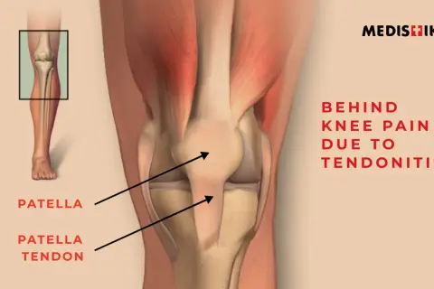 Anatomie du genou montrant le tendon derrière le genou, expliquant la douleur due à la tendinite.