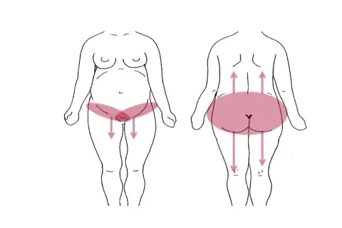 Schéma montrant les zones de douleur pelvienne chez la femme, avec des flèches indiquant la direction de la douleur.