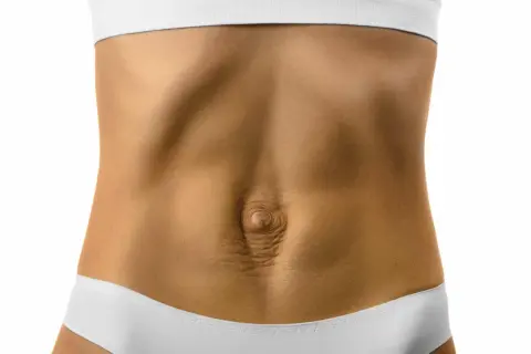 Ventre avec peau relâchée et vergetures, montrant un possible diastasis. Comment savoir si c'est le cas ?