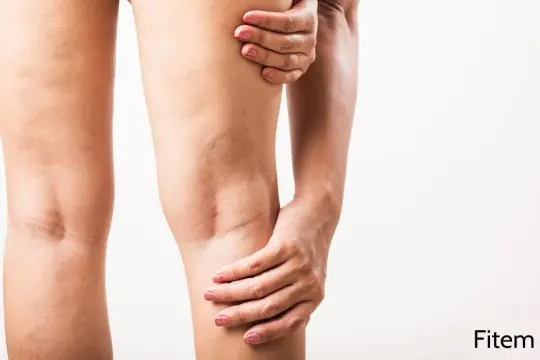 Une femme se tient la jambe, visiblement souffrante. La douleur à la jambe rend impossible de marcher.