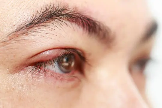 Gros plan sur un œil présentant un orgelet rouge et gonflé sur la paupière. Une solution naturelle pour le traitement de l'orgelet est recherchée.