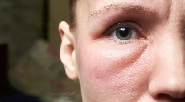 Un visage gonflé, peut-être à cause d'une allergie. On cherche un remède de grand-mère pour soulager cette paupière enflée.