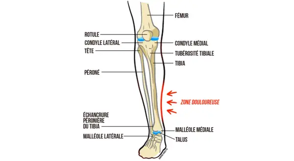 Schéma anatomique du tibia et du péroné, montrant la zone douloureuse typique de la périostite tibiale, suggérant des pistes pour le traitement.