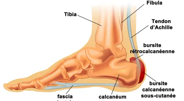 Anatomie du pied montrant le calcanéum, le fascia plantaire et le tendon d'Achille. Une bursite rétrocalcanéenne peut causer une tendinite sous le talon.