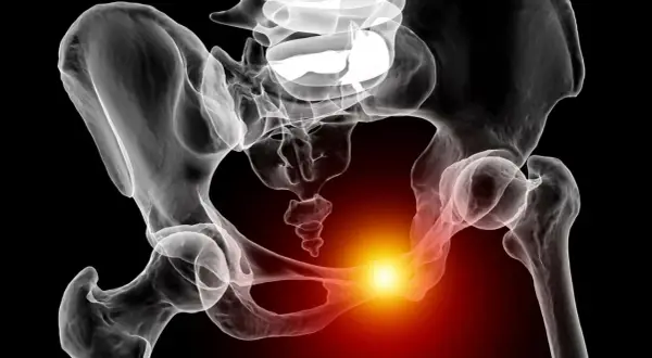 Radiographie du bassin humain montrant une zone de douleur vive au niveau de la symphyse pubienne, suggérant une douleur symphyse pubienne sans grossesse.