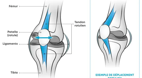 Illustration du genou : Fémur, rotule, ligaments, tibia. Une flèche bleue montre un déplacement rotulien. Que faire si mes genoux lâchent quand je marche ?
