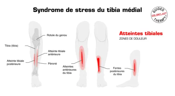 Schéma illustrant le syndrome de stress du tibia médial, avec des zones de douleur indiquées sur le tibia, pouvant signaler une fracture de fatigue tibia.