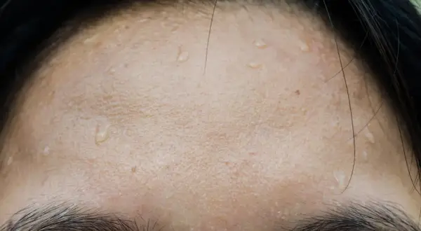 Gouttes de sueur sur le front, signe de transpiration excessive du visage.