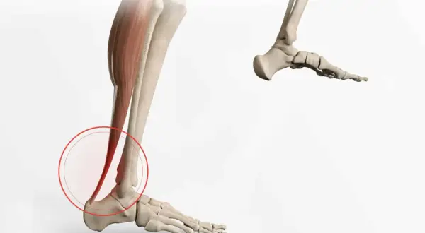 Illustration médicale montrant une calcification du tendon d'Achille, avec une zone rouge entourant la zone affectée.