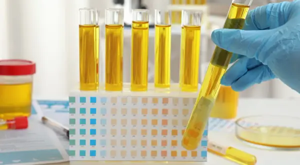Analyse d'urine en laboratoire. Des éprouvettes remplies d'urine jaune sont dans un support, à côté d'une bandelette réactive. Cela peut aider à comprendre combien de fois uriner par jour.