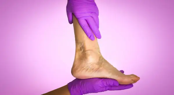 Mains gantées de violet soutiennent une jambe montrant des signes de mauvaise circulation sanguine.