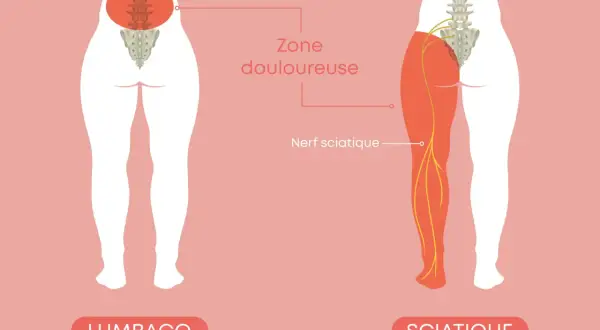 Illustration montrant le nerf sciatique et la zone douloureuse d'une sciatique jambe droite symptôme.