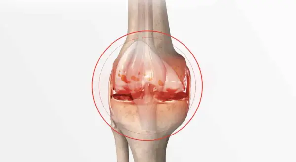 Illustration d'un genou montrant les symptômes d'une crise d'arthrose : cartilage usé et inflammation.