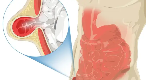 Illustration d'une hernie inguinale, montrant l'intestin sortant par une faiblesse de la paroi abdominale. Le pubis gonflé est une cause de douleur.