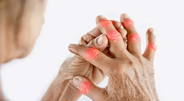 Mains montrant des articulations rouges et enflammées, symptomatiques d'une arthrose du doigt, même chez les jeunes.