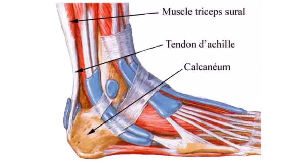 Anatomie du pied montrant le muscle triceps sural, le tendon d'Achille et le calcanéum. Illustration d'une tendinite du tendon d'Achille.