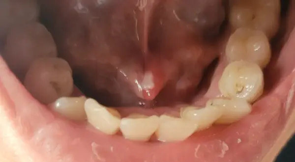 Un petit bouton blanc est visible sous la langue, près de la base. Les dents du bas sont également visibles.