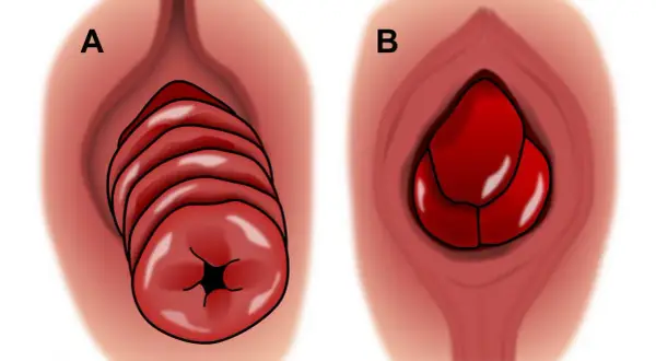 Illustration A montre un prolapsus rectal en plusieurs couches, tandis que B illustre un prolapsus d'organe chez l'homme.
