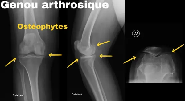 Radiographies du genou montrant un arthrose genou stade 4 avec ostéophytes marqués, rétrécissement de l'espace articulaire et déformations osseuses.