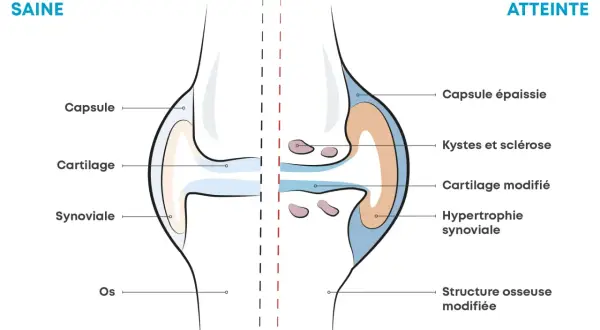 Comparaison d'une articulation saine et d'une articulation atteinte d'arthrose, montrant les symptômes : cartilage modifié, kystes, hypertrophie synoviale.