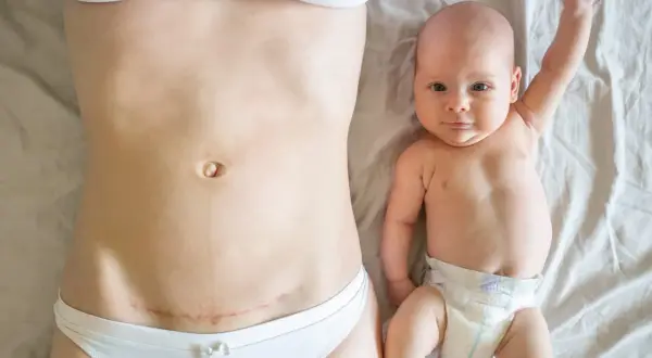 Ventre après césarienne, avec une cicatrice visible, à côté d'un bébé souriant.
