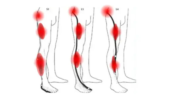 Schéma montrant les zones de douleur du nerf sciatique, incluant le mollet, avec des points rouges indiquant l'inflammation.