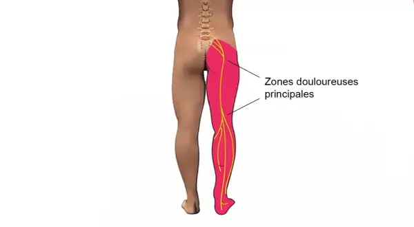Douleur irradiant de la fesse, le long de la cuisse, jusqu'au pied. Zones douloureuses principales.