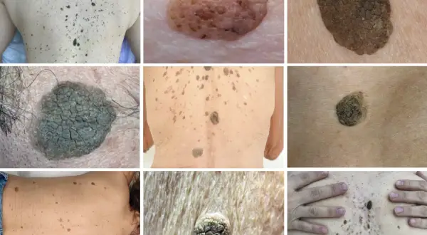 Diverses lésions cutanées, dont des kératoses séborrhéiques. Recherche d'un traitement naturel pour ces affections.