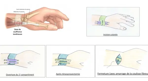 Illustrations montrant la zone de souffrance tendineuse au poignet, les étapes d'une ténosynovectomie et la fermeture. Ces symptômes de tendinite au poignet peuvent nécessiter une intervention.