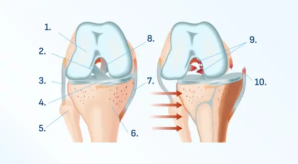 Illustration du genou montrant une déchirure ligamentaire interne. Aide à comprendre comment soigner douleur genou interne.