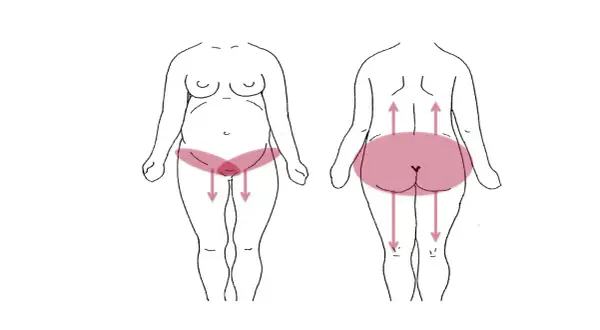 Schéma montrant les zones de douleur pelvienne chez la femme, avec des flèches indiquant la direction de la douleur.