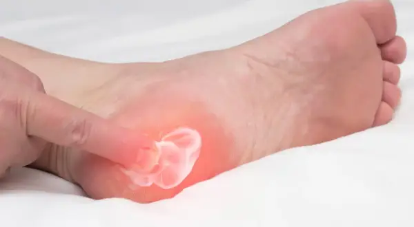 Application de crème sur un pied souffrant d'aponévrosite plantaire. L'alimentation joue un rôle clé dans la guérison.