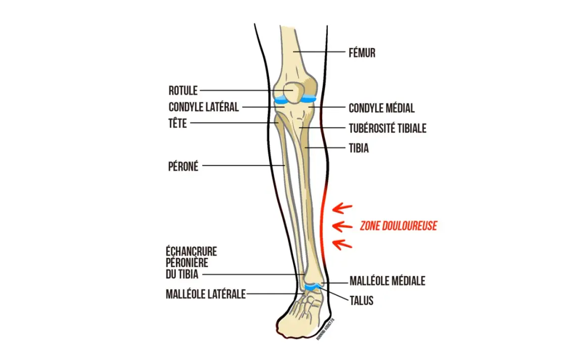 Schéma anatomique du tibia et du péroné, montrant la zone douloureuse typique de la périostite tibiale, suggérant des pistes pour le traitement.