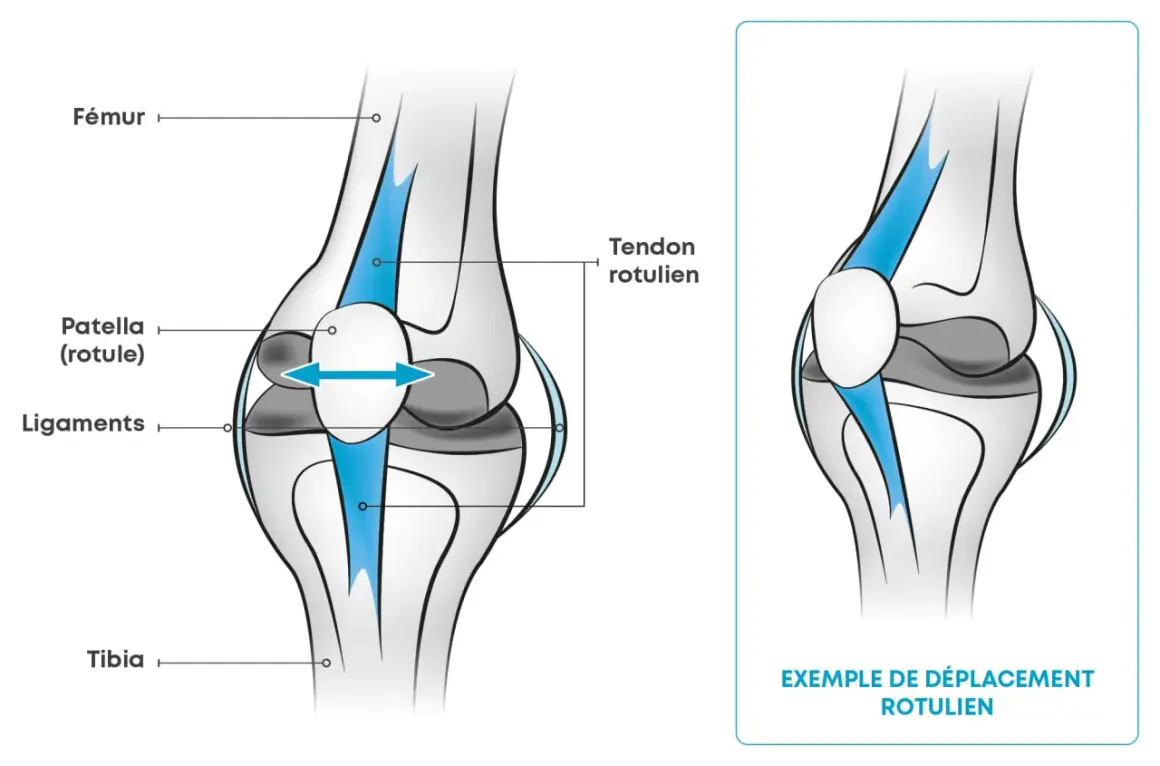 Illustration du genou : Fémur, rotule, ligaments, tibia. Une flèche bleue montre un déplacement rotulien. Que faire si mes genoux lâchent quand je marche ?
