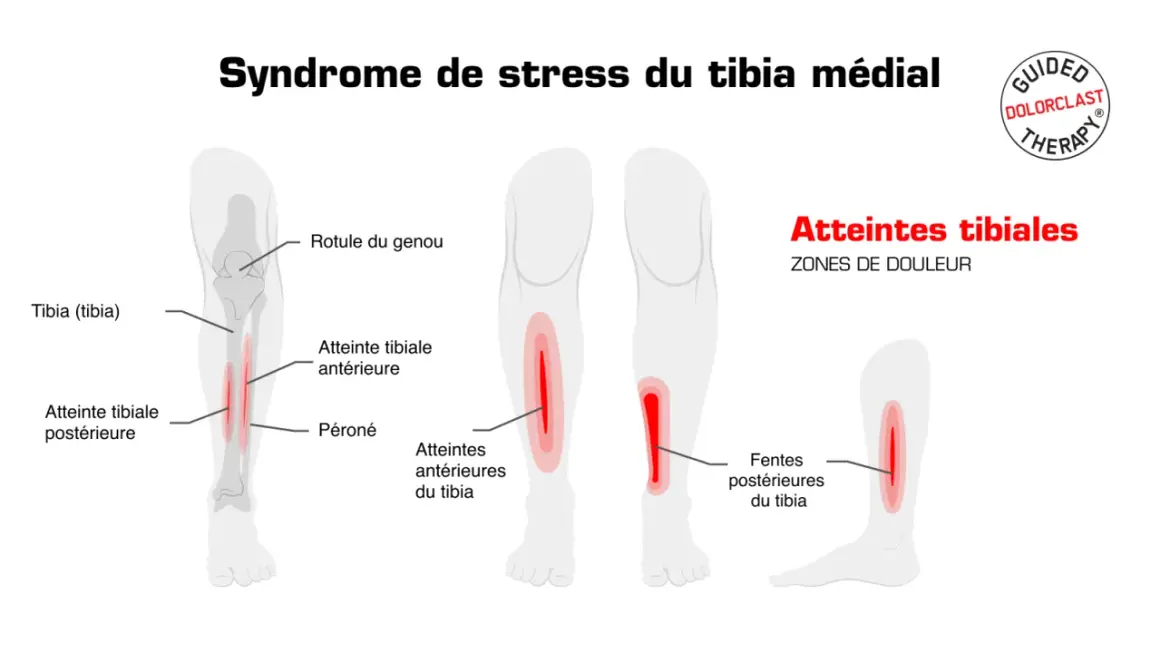 Schéma illustrant le syndrome de stress du tibia médial, avec des zones de douleur indiquées sur le tibia, pouvant signaler une fracture de fatigue tibia.