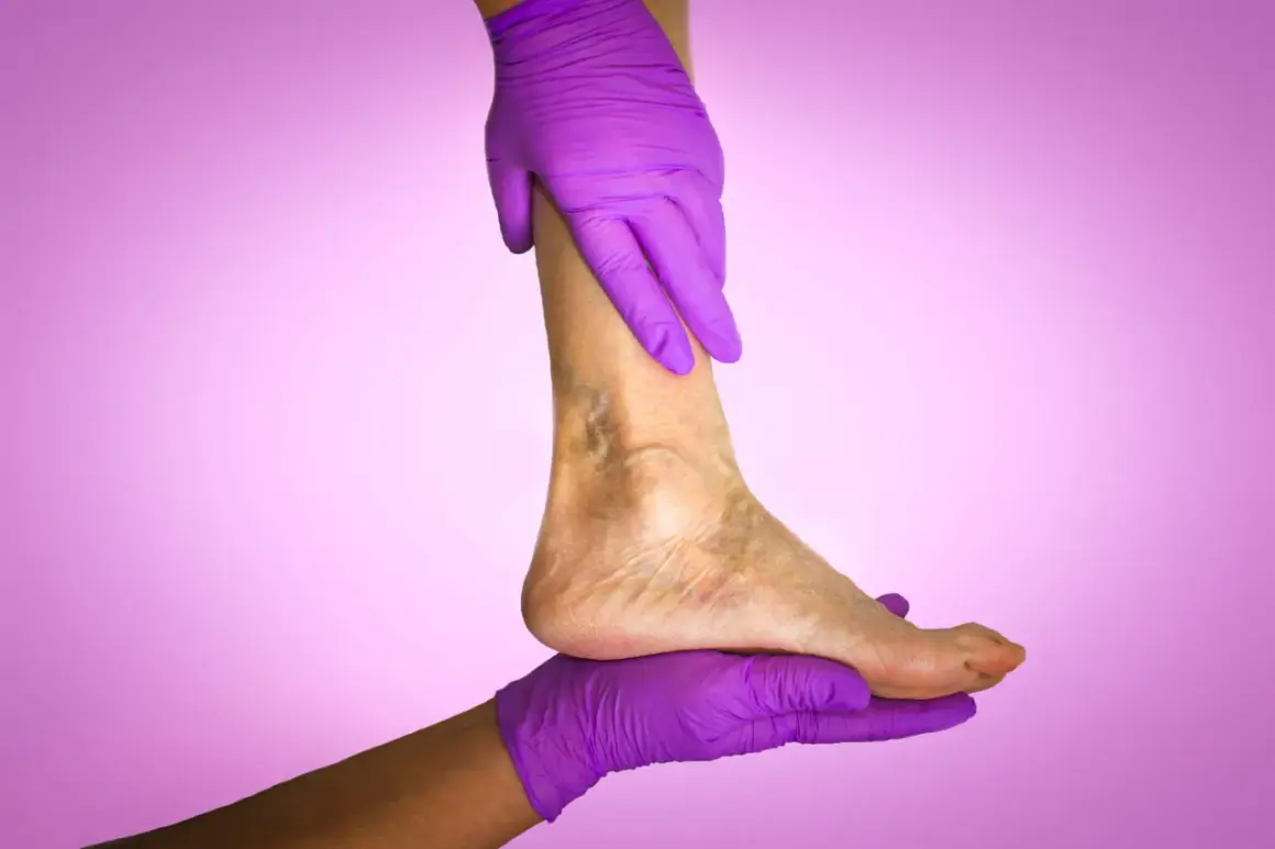 Mains gantées de violet soutiennent une jambe montrant des signes de mauvaise circulation sanguine.