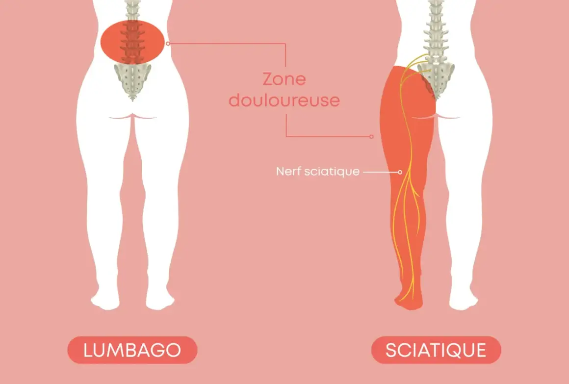 Illustration montrant le nerf sciatique et la zone douloureuse d'une sciatique jambe droite symptôme.